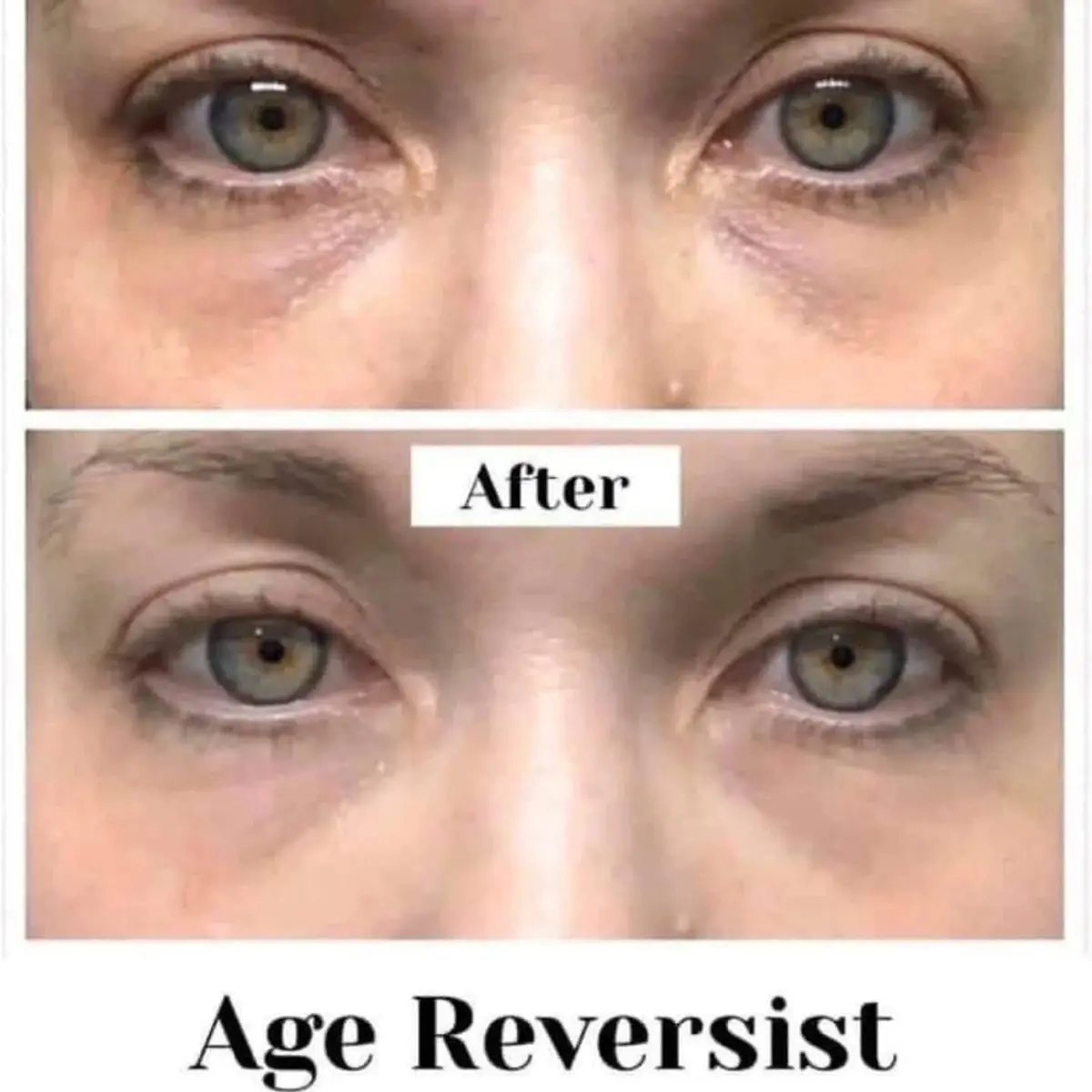 Botox efekat u kesicama