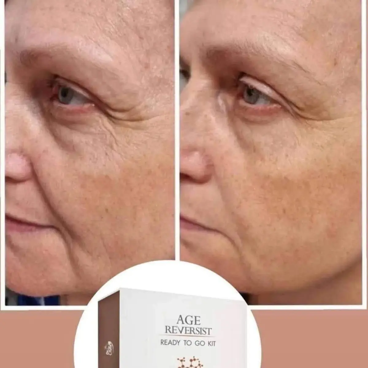 Botox efekat u kesicama